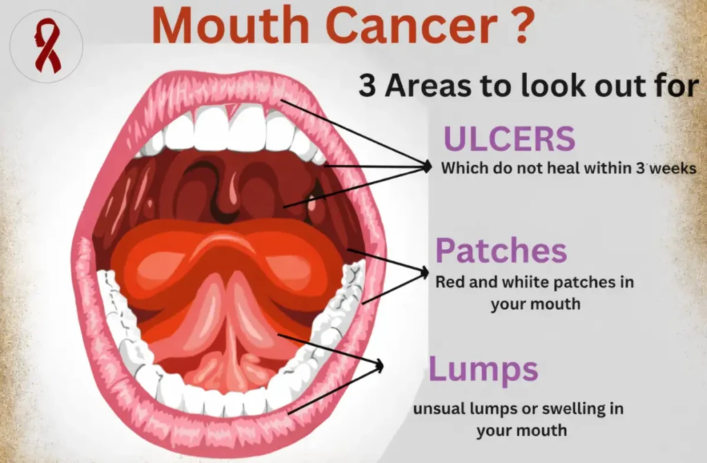 Mouth ulcer vs oral cancer