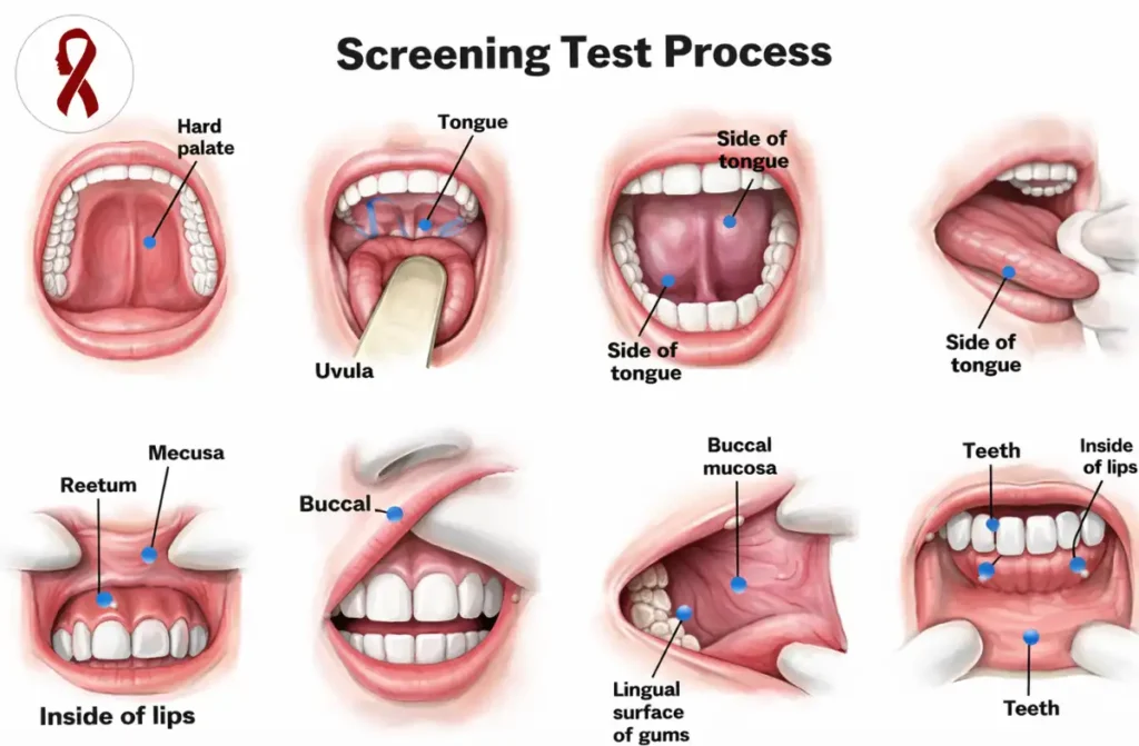 Floor of Mouth Cancer
